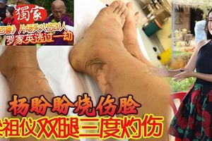 《大地回春》火災意外，楊盼盼燒傷臉,梁祖儀雙腿三度灼傷!