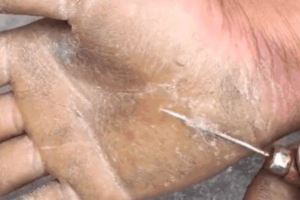 男子做搬運多年，某天突然感覺手掌疼痛，用針刺進手掌發現了真相