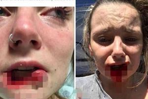拒復合遭咬掉嘴唇她狂滴血縫3百針