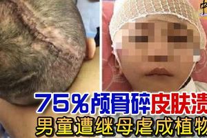 75%顱骨碎皮膚潰爛。。。。男童遭繼母毆打、捆綁、罰跪，虐成植物人！
