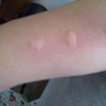 被蚊子咬後皮膚越抓越癢，教你個止癢絕招，只需10秒鐘止癢不留印痕