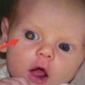 這位小男孩從小有一雙「雙色瞳孔」，父母覺得漂亮但兩歲時醫生檢查發現，眼裡長著超多噁心東西！…