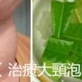 【治療大頸泡的驗方】什麼樣的人容易得甲狀腺結節？轉發功德無量~