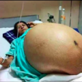印度女子一口氣生下11胞胎，破了世界記錄！生完她的肚皮成了這樣…