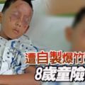 8歲男童點燃自製爆竹，結果險些失明！