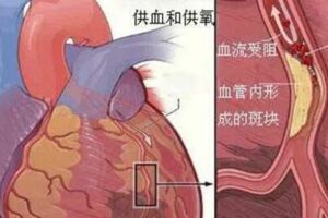 急性胸痛鑑別非常重要，三種極易致死的胸痛該如何鑑別