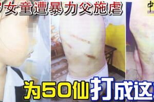 8歲女童遭暴力父施虐為50仙打成這樣