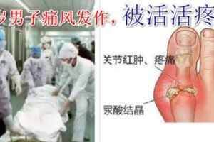 53歲男子被活活疼死！痛風有多痛？這些食物一定要忌口！