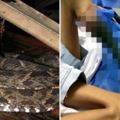 慎入！13歲女孩被毒蛇咬傷接受「土法治療」　腿部竟然只剩下「枯黑腐爛骨頭」
