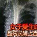 女子愛生吃豬肉腿內長滿上百寄生蟲