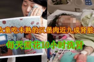 【內附視頻】4歲女童吃未熟的漢堡肉近九成腎髒損傷每天需花10小時洗腎