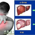 他不顧右肩酸痛，結果等發現時，「肝」已經爛到不能再爛，連醫生都束手無策，後悔莫及！