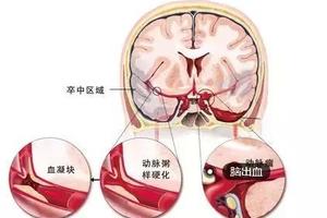 血管堵沒堵，抬腳便知！1個動作6種食物讓全身血液暢通！