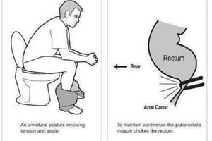 坐馬桶姿勢 竟可能導致大腸癌機率增加！