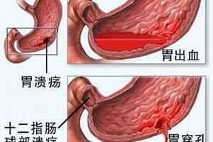 消化性潰瘍怎麼辦？調節心情、釋放壓力、合理飲食才是關鍵！