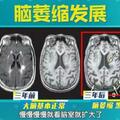 30歲的人80歲的大腦，《我是大醫生》帶您了解易被忽視的腦缺氧！