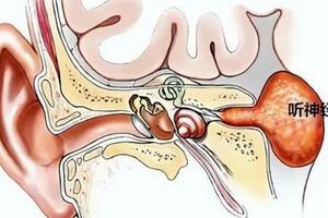 頭暈、耳鳴、聽力下降？當心碰上聽神經瘤