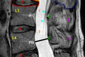 （收藏）腰椎MRI怎麼閱片呢？腰椎間盤突出如何看？零基礎可讀懂