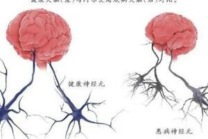 世界阿爾茨海默病日：全球患者將過億，新療法有望逆轉大腦衰老嗎