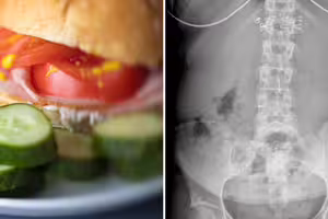 「常吃1早餐」引發大腸癌 研究證實:強力致癌物 「常吃1早餐」引發大腸癌 研究證實:強力致癌物