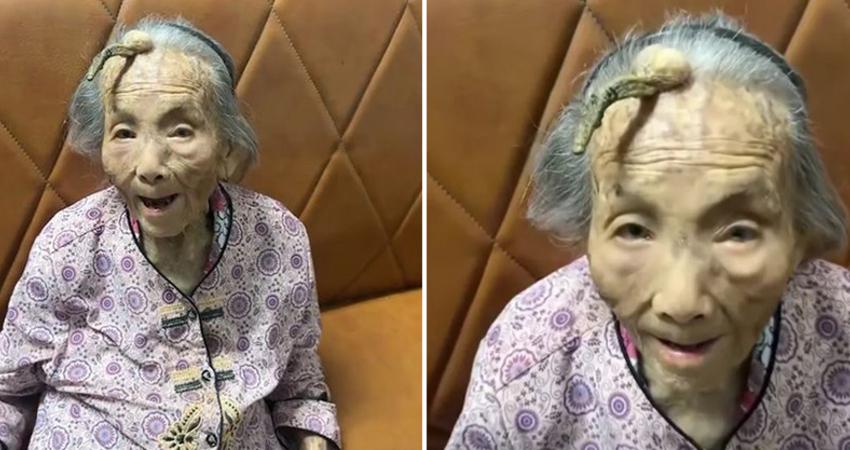 107歲老奶奶「額頭長角」！兒孫嗨喊「長壽象徵」　醫一看驚：快切掉