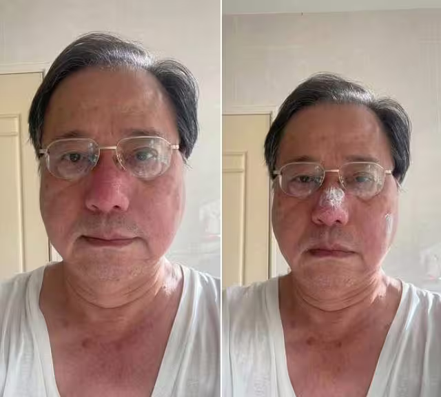 李來希PO出被蜜蜂螫到鼻樑的照片,自嘲「鼻樑腫脹猶似豬八戒,保全系統人臉辨識失敗」。(圖/翻攝自李來希臉書) 李來希PO出被蜜蜂螫到鼻樑的照片,自嘲「鼻樑腫脹猶似豬八戒,保全系統人臉辨識失敗」。(圖/翻攝自李來希臉書)