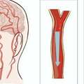 關於腦卒中，這是一篇最全科普