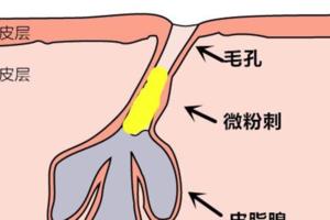 讓你抓狂的閉合型粉刺該何去何從