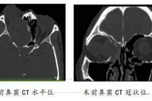 眼球突出、視力下降 原來是鼻竇里長了個大囊腫