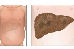 肝硬化能早知道嗎？醫生教你識別這些症狀和跡象