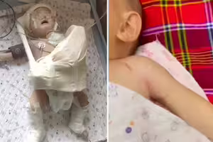 難產「扯斷男嬰手臂」媽崩潰　醫：不拉斷出不來