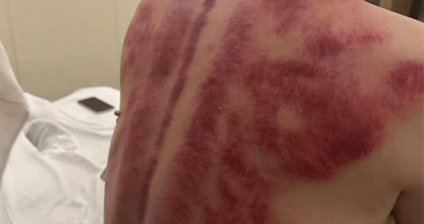 澎恰恰赴陸拍戲還債！背部「滿滿血痕照」嚇壞網 嘆：還好撐住了
