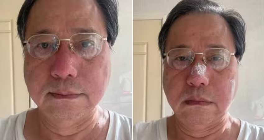 有夠慘！被蜂螫鼻樑曬照嘲「腫脹似豬八戒」 李來希：腫到人臉辨識失靈