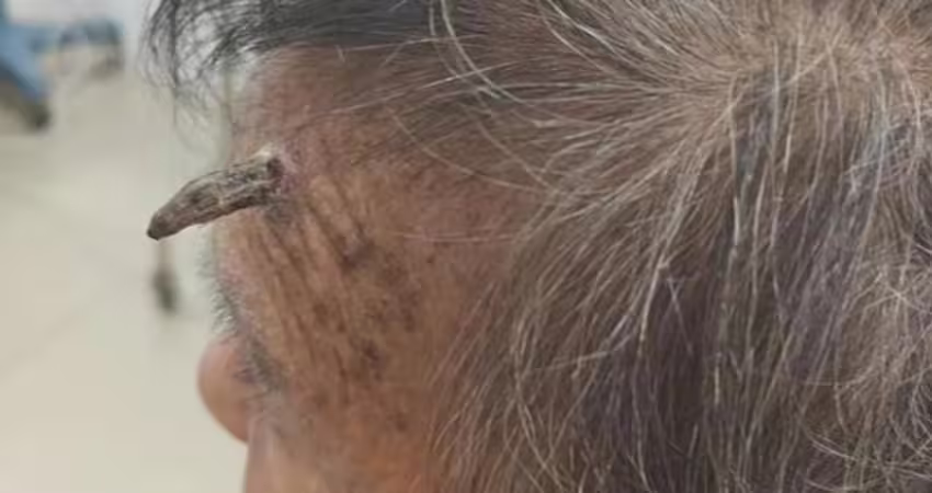 98歲嬤「頭上長角」！竟「自行剪斷」急送醫　驚人真相曝光