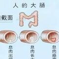 為什麼腸道容易長息肉？醫生提醒：或許與這幾個原因有關