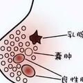 乳腺結節，可以吃「洋蔥」嗎？提醒：保養乳腺，要少吃哪些食物？