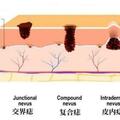 普通痣和黑色素瘤，如何科學辨別