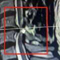 男子按摩按出頸椎病，這些情況下不適合按摩