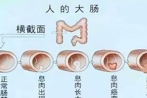 為什麼腸道容易長息肉？醫生提醒：或許與這幾個原因有關