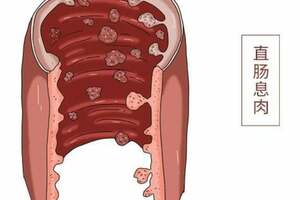 長了腸息肉，到底要不要切？腸息肉和腸癌有什麼關係？不妨了解