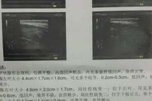 甲狀腺腫、結節，淋巴結結核，消瘰丸，化痰消腫，軟堅散結。