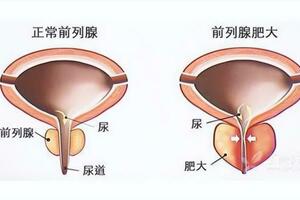 前列腺炎，這個老方有奇效，但有幾類人不適用