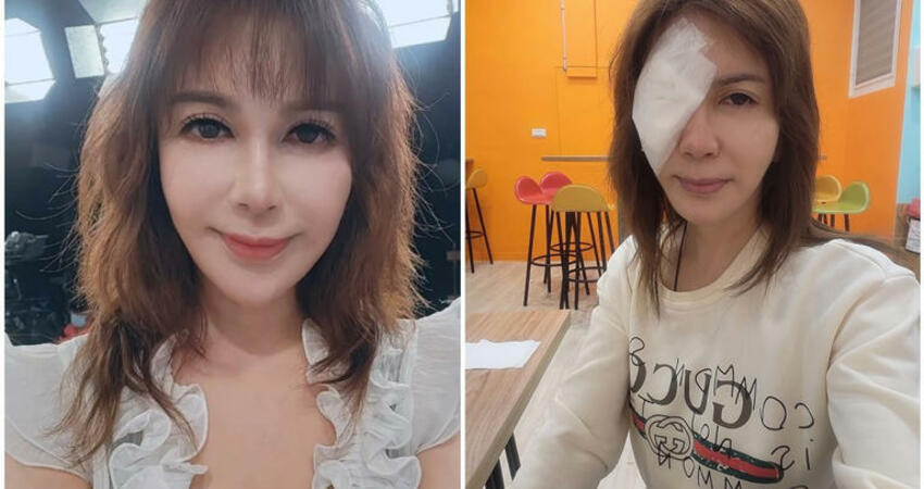 前主播眼睛「出現疊影白霧」 查1年才找出這原因 動刀2次身心俱疲