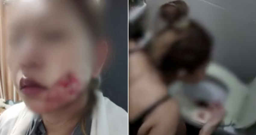 女子花2千元想「酒窩整形」！慘「凹成血窟」爆血暈死