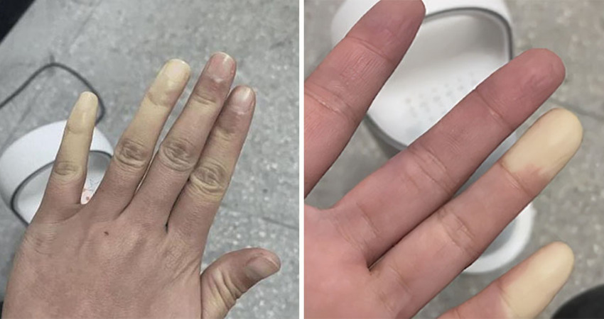 女老師曬照抱怨「冬天手腳冰冷」　醫科生一看急喊「這是病快就醫！」