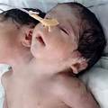 印度「罕見雙頭男嬰」出生時健康被醫生稱為奇蹟，但爸媽不理醫生建議變成悲劇。
