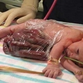 醫生建議媽媽墮胎但她不聽，堅持生下「內髒在體外的寶寶」8個月後… 