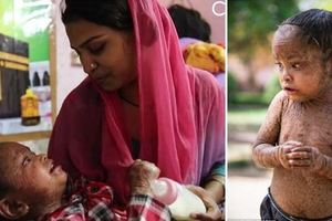 印度2歲女孩罹怪病，天天脫皮甚至長出「蜥蜴鱗片」，母親痛心坦承：「有時希望她死掉！」 