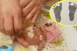 提早4個月出生的女嬰腳印只有硬幣大小般，沒想到經過9個月的滋潤後她的現況讓醫生直呼生命奇蹟 