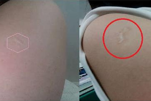 台灣人才有的「特殊印記」！女子手臂光滑「開始擔憂」網友：「是幸運的那10%」 
